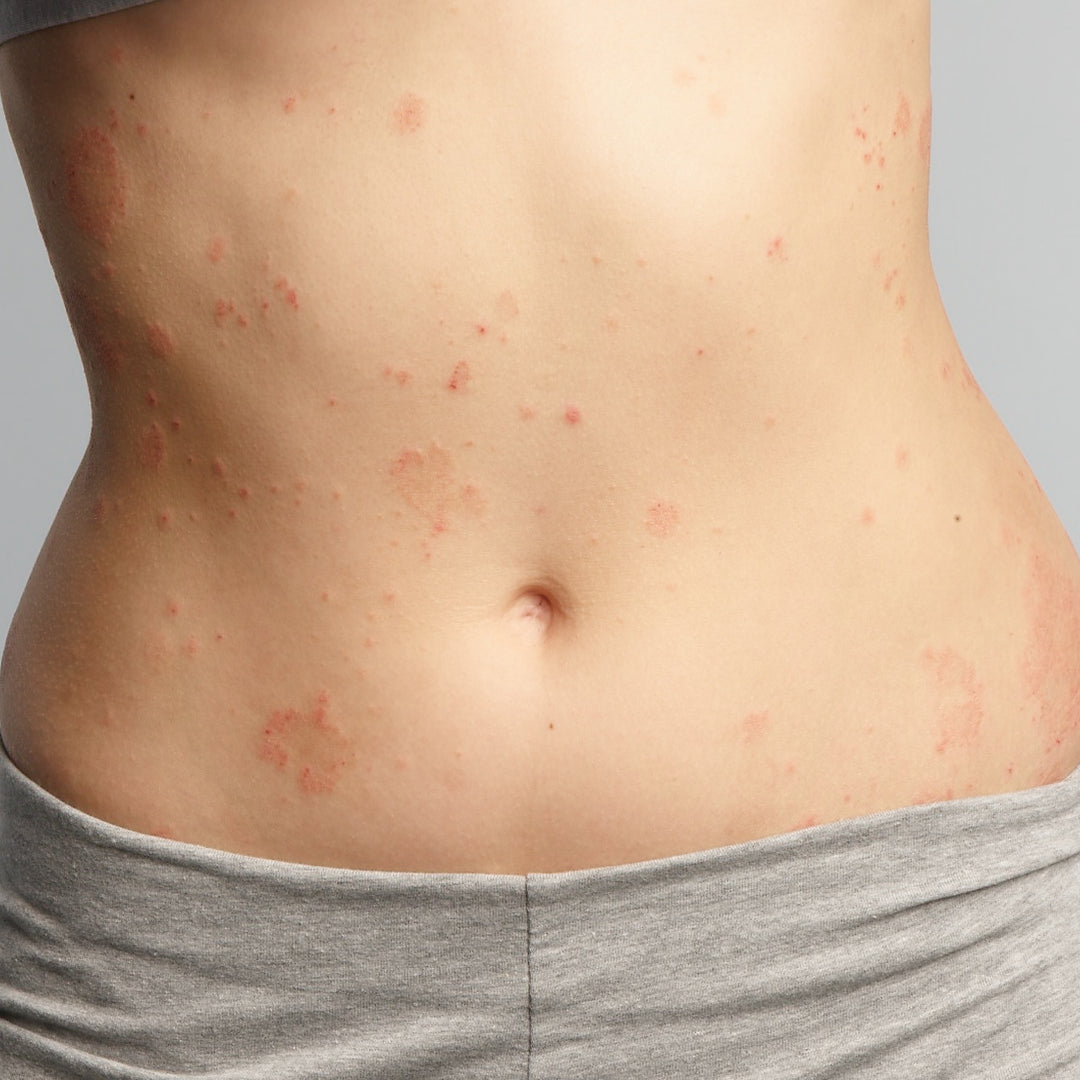 Bauch mit Neurodermitis
