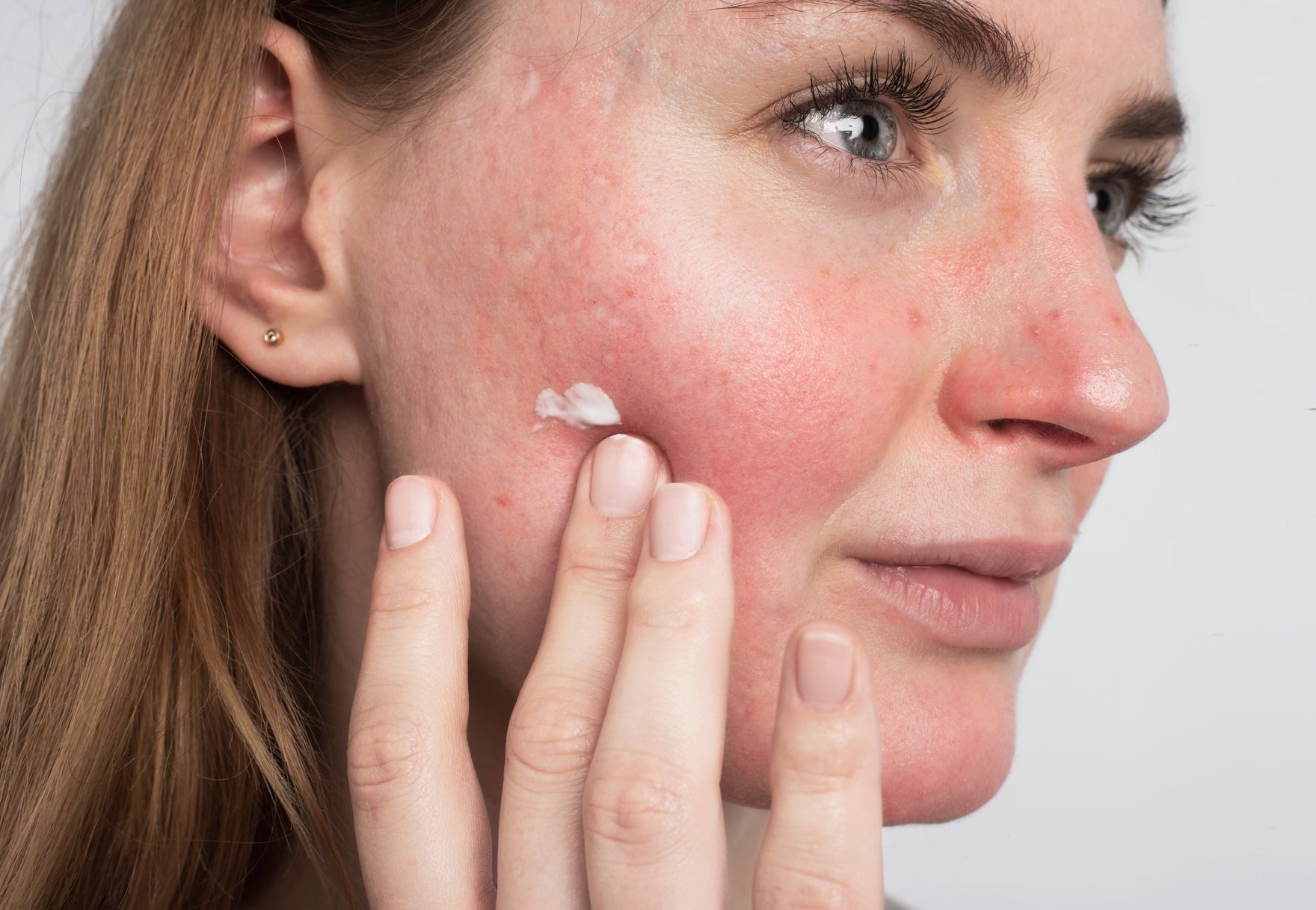 April ist der Rosacea Awareness Month